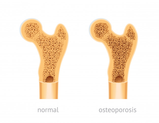 Osteoporosi: come prevenirla con il calcolo della densità ossea