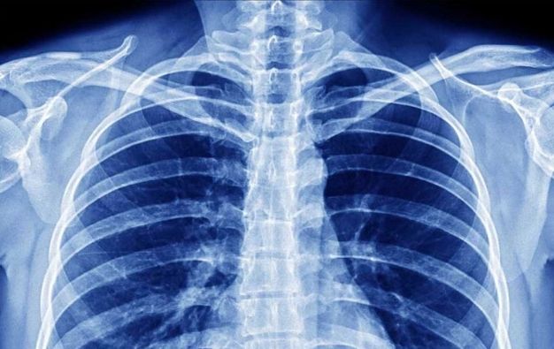 Radiografia Emitorace: informazioni utili