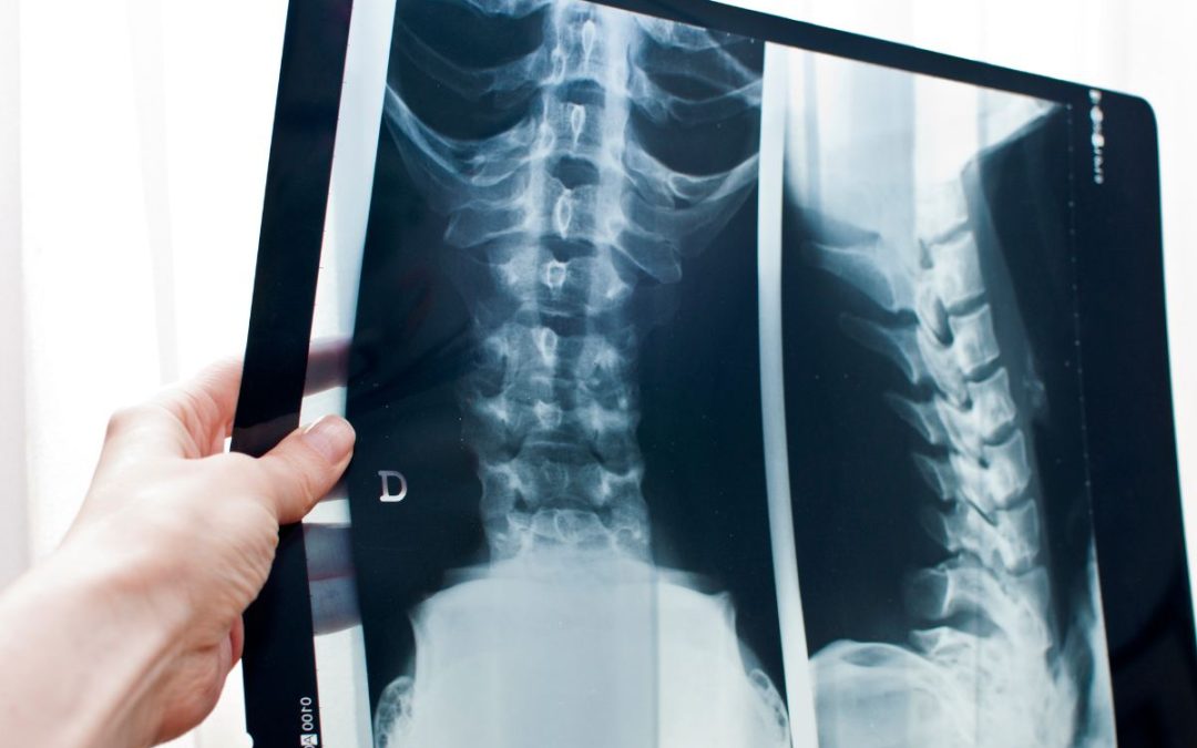 Radiografia alla schiena, quali patologia aiuta a diagnosticare.